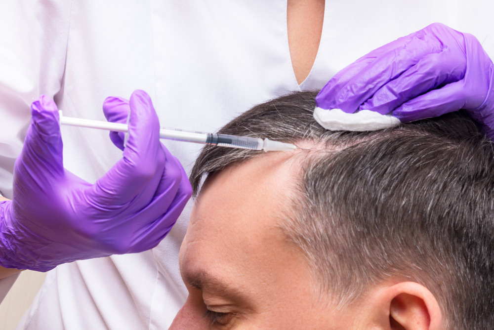 PRP Treatments for the Scalp - Slowing and Reversing Hair Loss for Men and  Women - EasyBlog - Calvine Medical Aesthetics Calvine Medical Aesthetics