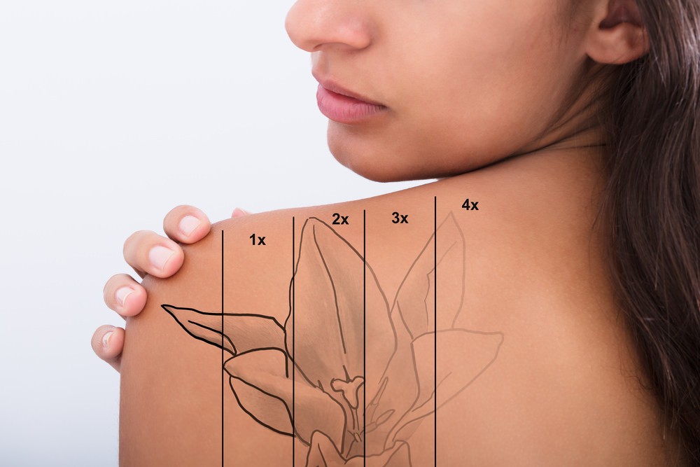 How Laser Tattoo Removal Works - EasyBlog Calvine Medical Aesthetics