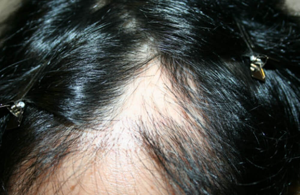 Male Hair Restoration - Before
